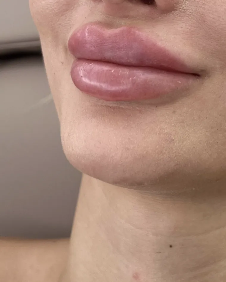 Lippen nach einer Unterspritzung, seitliches Profil.