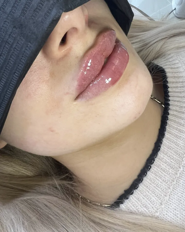 Lippen nach einer Unterspritzung, Dreiviertelansicht.