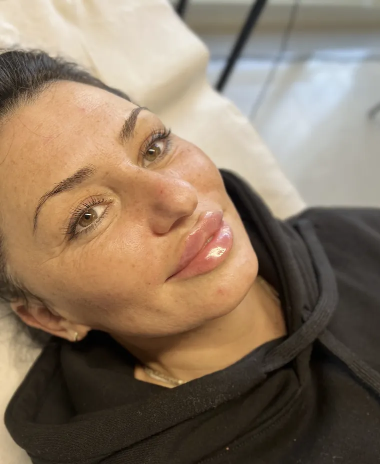 Lippen nach einer Unterspritzung im Sitzen.