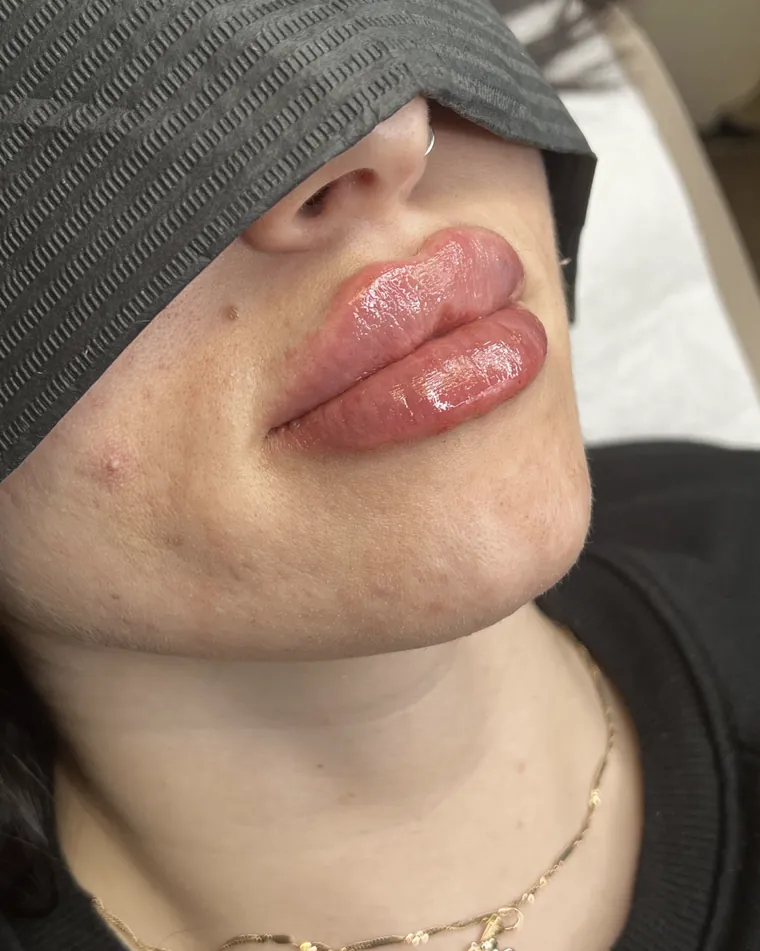Lippen nach einer Unterspritzung, Nahaufnahme.